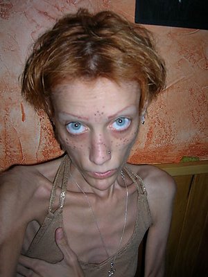anorexia6