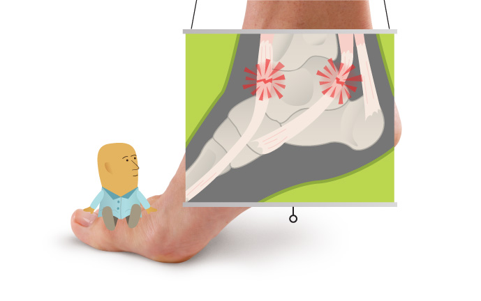 Anyone can develop ankle tendinitis, but those who are not well conditioned to physical exercise may be more at risk; flat-footed individuals may be more prone to it as well.