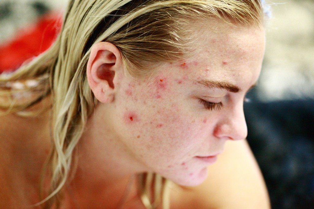 7 Unexpected Acne Breakout Triggers (Sleep Plays A Crucial Role)